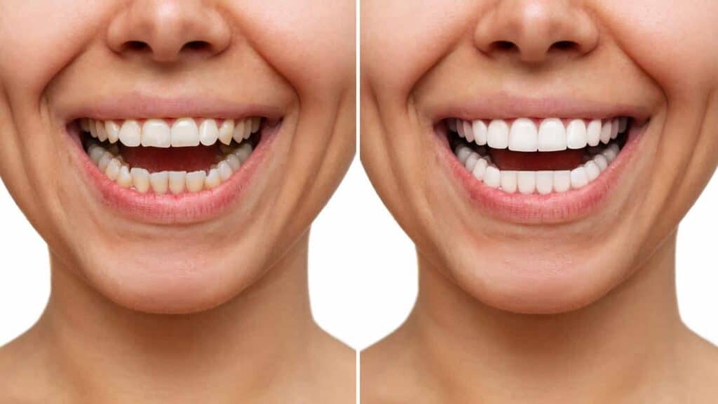 Contact Aspire White for teeth whitening services – Get in touch with Blackburn today