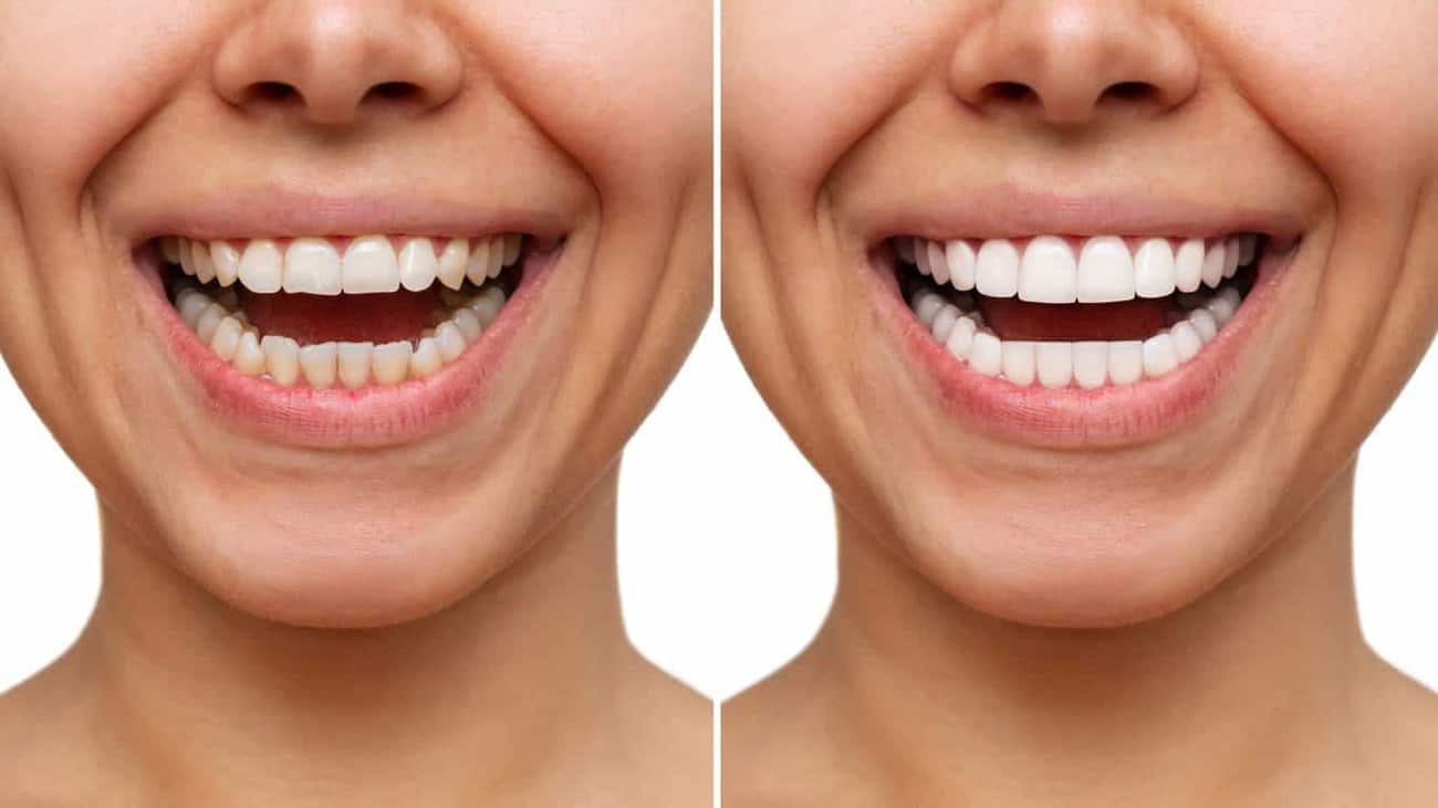 Contact Aspire White for teeth whitening services – Get in touch with Blackburn today