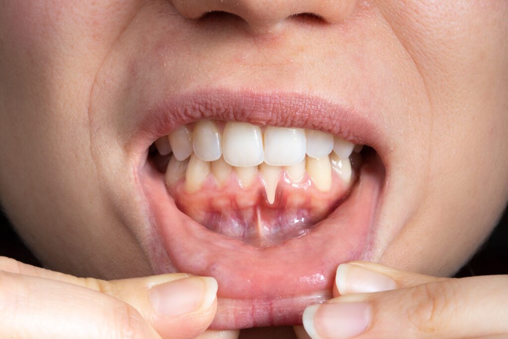 Preparing for teeth whitening with receding gums Blackburn