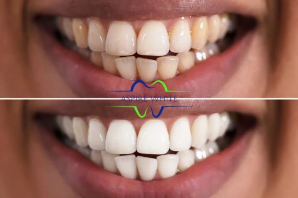 Aspire White customer before and after Blackburn results.