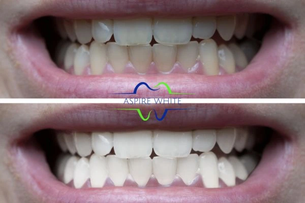 1 hour laser teeth whitening before and after results Blackburn