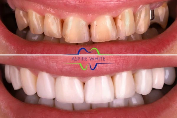 Yellow teeth results - 1 hour whitening before and after results Blackburn