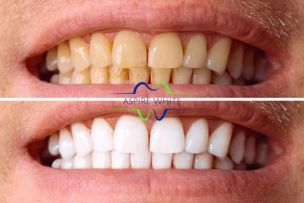 Get noticeable whiter smile in just one hour! Book your teeth whitening treatment Blackburn today!
