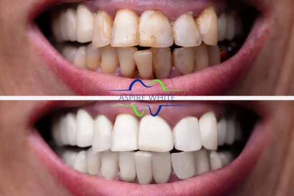 Before and after results of laser teeth whitening Blackburn Book in online today!