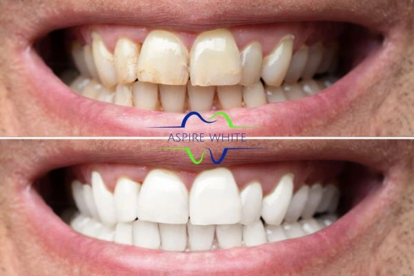 Achieve a radiant smile with professional laser teeth whitening Blackburn